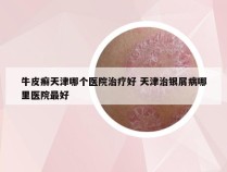 牛皮癣天津哪个医院治疗好 天津治银屑病哪里医院最好