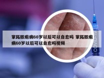 掌跖脓疱病60岁以后可以自愈吗 掌跖脓疱病60岁以后可以自愈吗视频