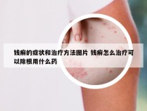 钱癣的症状和治疗方法图片 钱癣怎么治疗可以除根用什么药