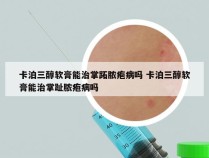 卡泊三醇软膏能治掌跖脓疱病吗 卡泊三醇软膏能治掌趾脓疱病吗