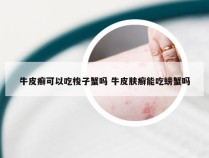 牛皮癣可以吃梭子蟹吗 牛皮肤癣能吃螃蟹吗