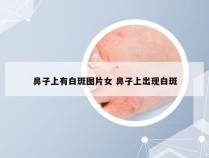 鼻子上有白斑图片女 鼻子上出现白斑