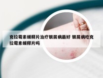 克拉霉素缓释片治疗银屑病最好 银屑病吃克拉霉素缓释片吗