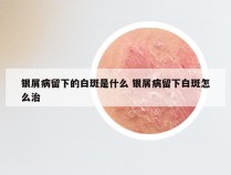 银屑病留下的白斑是什么 银屑病留下白斑怎么治