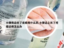 小便旁边长了皮癣用什么药 小便边上长了疙瘩还痒怎么办