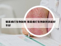 银屑病打生物制剂 银屑病打生物制剂到底好不好