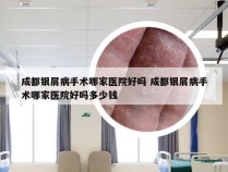 成都银屑病手术哪家医院好吗 成都银屑病手术哪家医院好吗多少钱