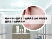 郑州有哪个医院治疗皮肤病比较好 郑州哪里医院治疗皮肤疾病好