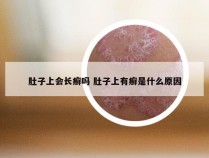 肚子上会长癣吗 肚子上有癣是什么原因