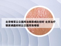 北京哪家公立医院治银屑病比较好 北京治疗银屑病最好的公立医院有哪些