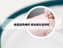 癣是遗传病吗 癣会隔代遗传吗