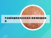 牛皮癣和扁桃体发炎有关吗 银屑病和扁桃体炎