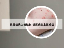 银屑病头上长脓包 银屑病头上起疙瘩