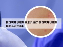 慢性斑片状银屑病怎么治疗 慢性斑片状银屑病怎么治疗最好