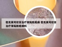 他克莫司软膏治疗掌跖脓疱病 他克莫司软膏治疗掌跖脓疱病吗