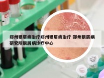 郑州银屑病治疗郑州银屑病治疗 郑州银屑病研究所银屑病诊疗中心