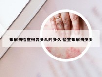 银屑病检查报告多久药多久 检查银屑病多少