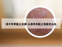 孩子冬季腿上长癣 小孩冬天腿上有癣怎么办