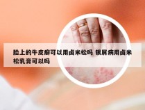 脸上的牛皮癣可以用卤米松吗 银屑病用卤米松乳膏可以吗