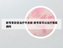 肤专家软膏治疗牛皮癣 肤专家可以治疗银屑病吗