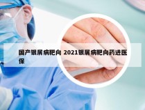 国产银屑病靶向 2021银屑病靶向药进医保