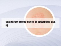 银屑病和肥胖纹有关系吗 银屑病胖瘦有关系吗