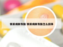 银屑病脚发酸 银屑病脚发酸怎么回事