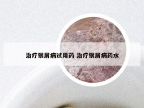 治疗银屑病试用药 治疗银屑病药水