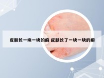 皮肤长一块一块的癣 皮肤长了一块一块的癣