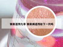 银屑遗传几率 银屑病遗传给下一代吗