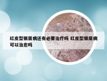 红皮型银屑病还有必要治疗吗 红皮型银屑病可以治愈吗