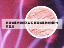 银屑病生物制剂怎么买 银屑病生物制剂价格及费用