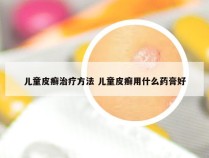 儿童皮癣治疗方法 儿童皮癣用什么药膏好