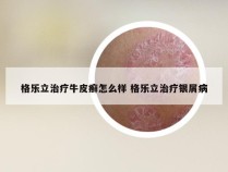 格乐立治疗牛皮癣怎么样 格乐立治疗银屑病