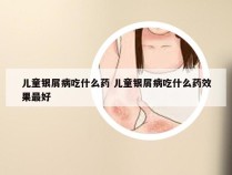 儿童银屑病吃什么药 儿童银屑病吃什么药效果最好