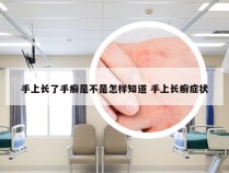 手上长了手癣是不是怎样知道 手上长癣症状