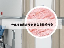 什么样的癣会传染 什么皮肤癣传染