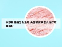 头部银屑病怎么治疗 头部银屑病怎么治疗效果最好