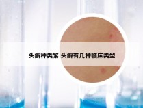 头癣种类繁 头癣有几种临床类型