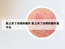 脸上长了白斑的图片 脸上长了白斑的图片是什么