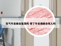 生气牛皮癣会复发吗 得了牛皮病癣会死人吗