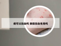 癣可以放血吗 脚藓放血有用吗