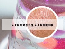 头上长癣会怎么样 头上长癣的症状