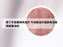 得了牛皮廨如何治疗 牛皮廨治疗目前有没有彻底根治的