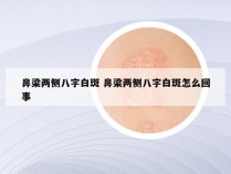 鼻梁两侧八字白斑 鼻梁两侧八字白斑怎么回事