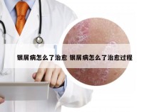 银屑病怎么了治愈 银屑病怎么了治愈过程