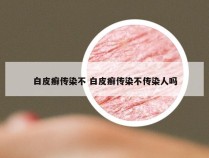 白皮癣传染不 白皮癣传染不传染人吗