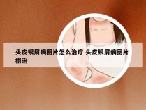 头皮银屑病图片怎么治疗 头皮银屑病图片 根治