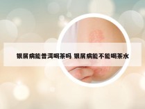 银屑病能普洱喝茶吗 银屑病能不能喝茶水