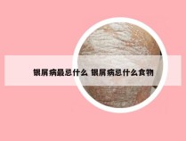 银屑病最忌什么 银屑病忌什么食物